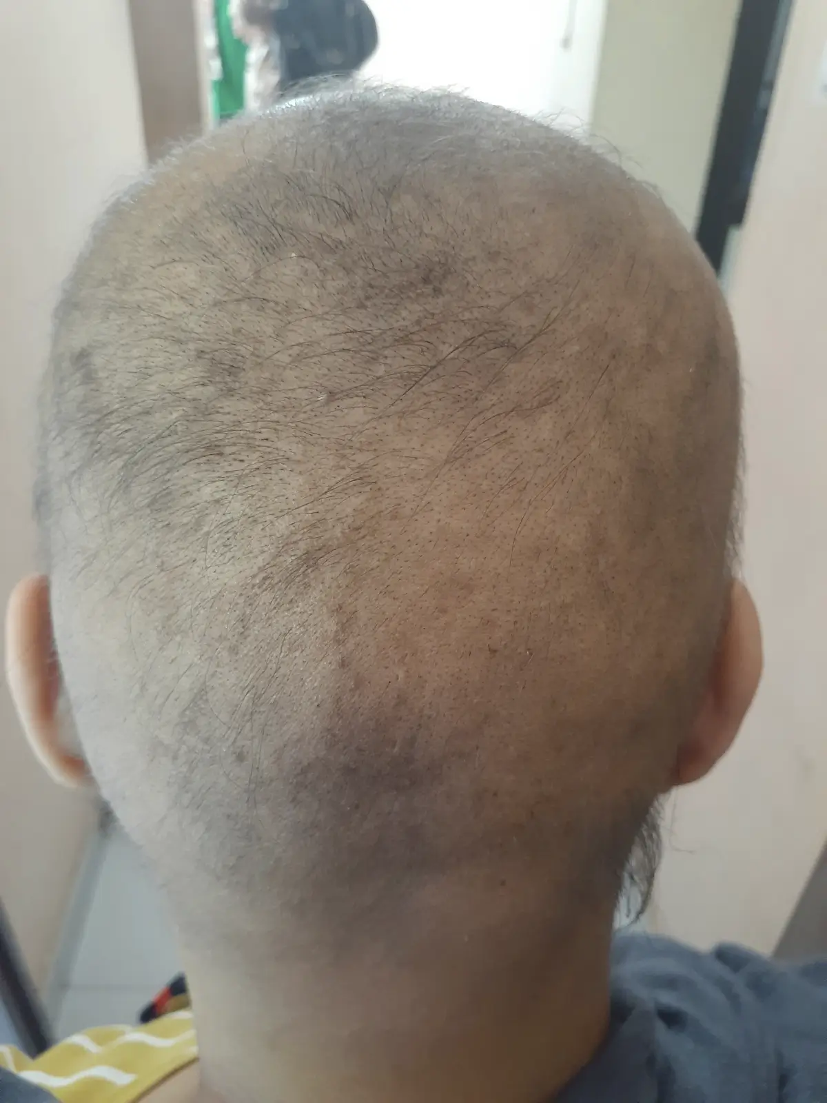 Alopecia Areata case 3 before treatment
